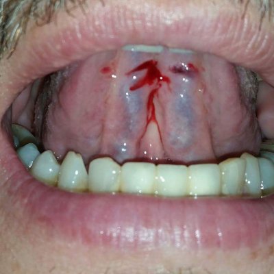  Dil altı hacamatı karaciğer temizliğinde faydalıdır