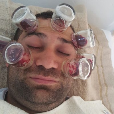 yüzfelci hacamat ve sinüzüt tedavisi